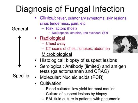 aiding the diagnosis of fungal disease .